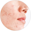 hyperpigmentation-photo